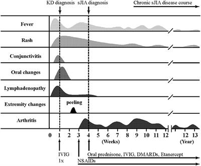 Kawasaki Disease and Systemic Juvenile Idiopathic Arthritis – Two Ends of the Same Spectrum